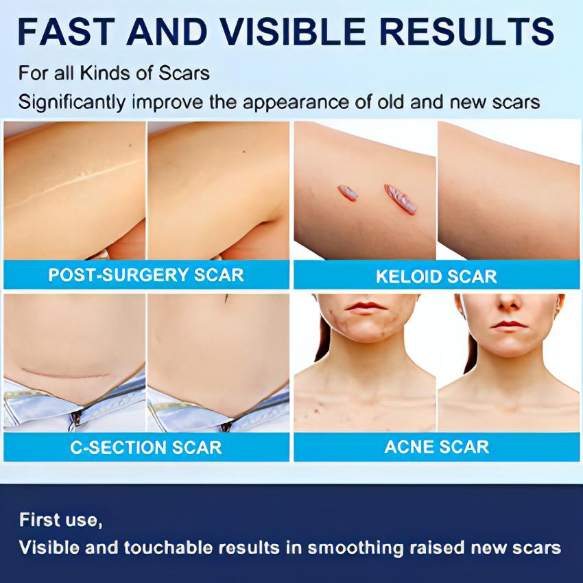 Scar Removal Silicone Gel Sheet | Fades C-Section Scars, Acne Scars, Wound & Operation Scars - NextMamas