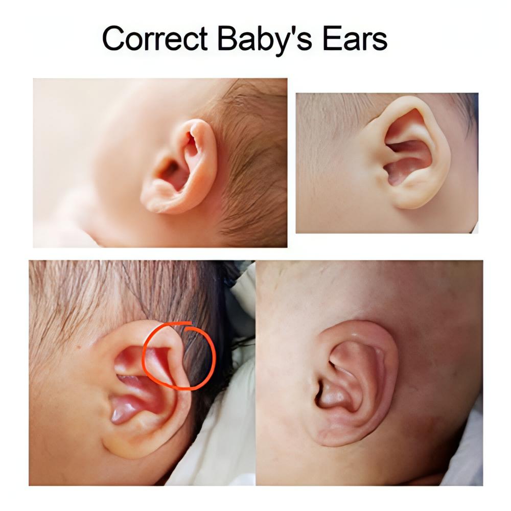 Children Ear Correction | Baby Silicone Gel Ear Corrector - NextMamas
